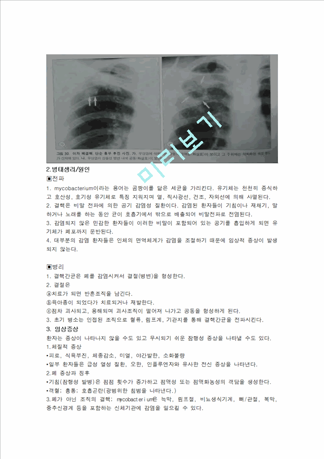 [간호학]폐결핵-Pulmonary Tuberculosis   (4 )